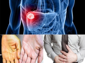 Ung thư gan di căn sang xương là gì? Những biến chứng nguy hiểm của ung thư gan di căn sang xương
